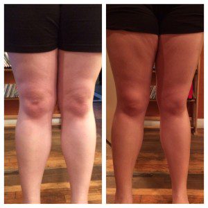 before and after legs